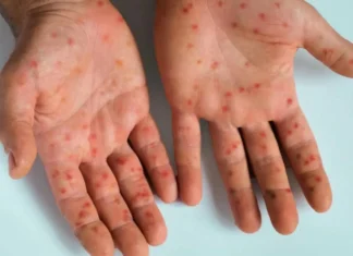 Recrudescence historique de la rougeole au Canada Recrudescence historique de la rougeole au Canada