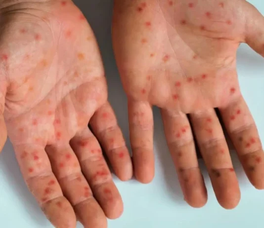 Recrudescence historique de la rougeole au Canada Recrudescence historique de la rougeole au Canada