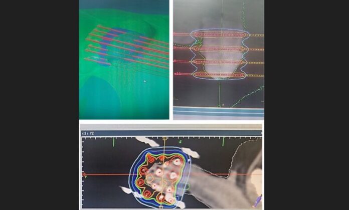 Oncorad Group fait avancer la curiethérapie de précision